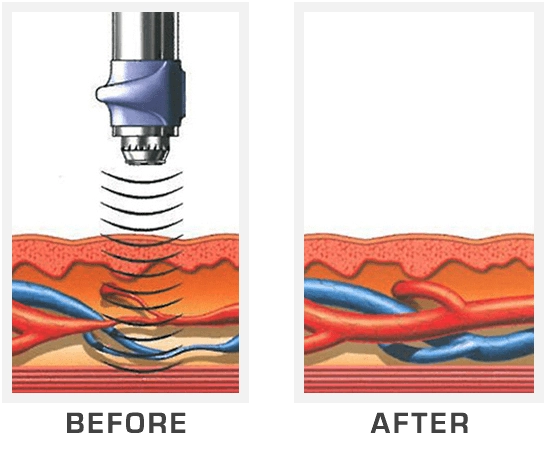 Performance Max Wave Therapy Jacksonville FL Before After